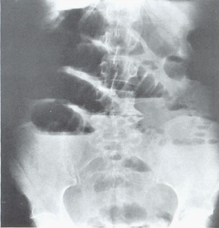 x-buik vloeistofspiegels door ileus.GIF (149154 bytes)