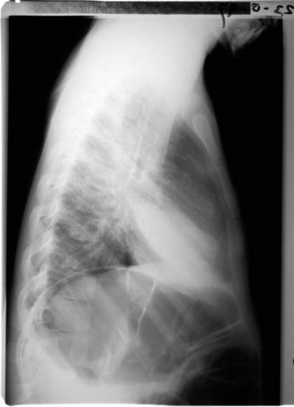 x-thorax pneumonie lateraal.JPG (17268 bytes)
